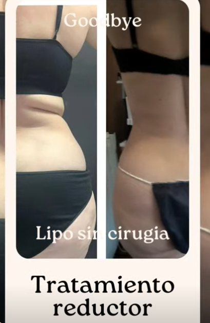 Lipo sin cirugía